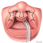 michael cooley: Michael A. Cooley, Bilateral Cleft Lip Rx Step 1, 2011, Digital. Step 1 in surgical treatment of bilateral cleft lip dep